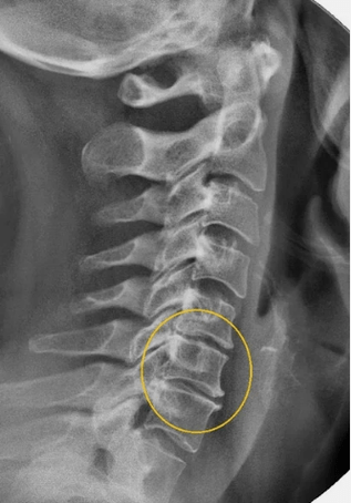 Osteochondrose der Halswirbelsäule auf einem X -Strahlen